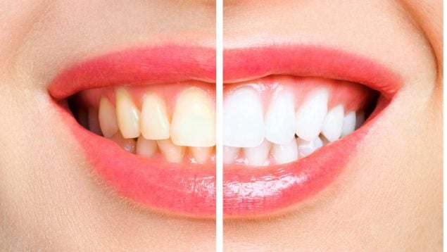 Los dientes amarillos