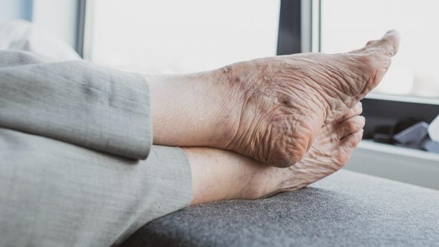 Consejo de los médicos para evitar pies hinchados en personas mayores, reducir edemas en jubilados, evitar hinchazón en los pies en la tercera edad, cómo reducir retención de líquidos en piernas.