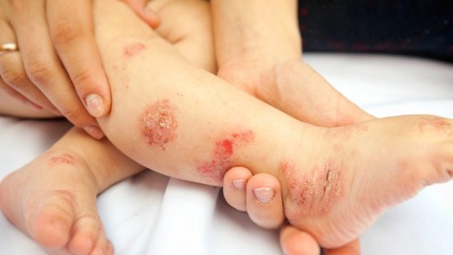 dermatitis atópica