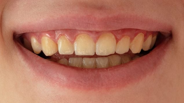 Los dientes amarillos