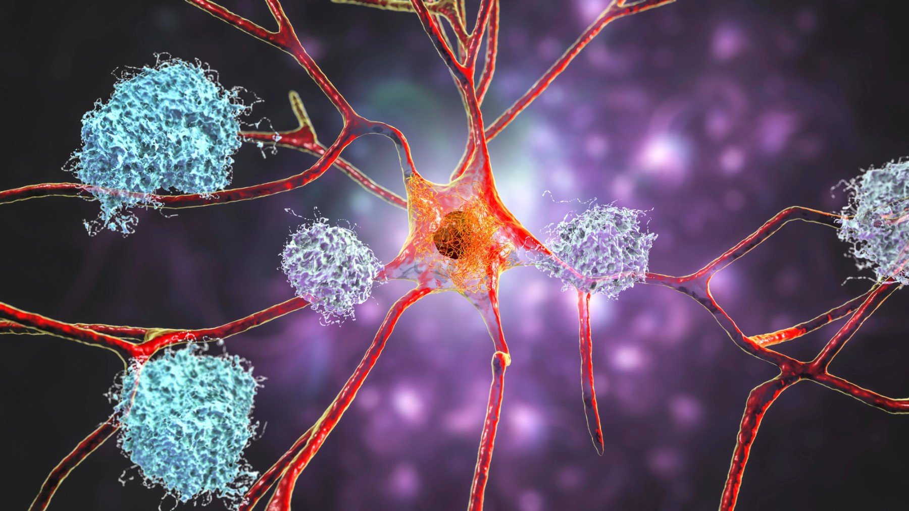 Europa rectifica y aprueba un innovador tratamiento contra el Alzheimer: ¿cuándo llegará a España?