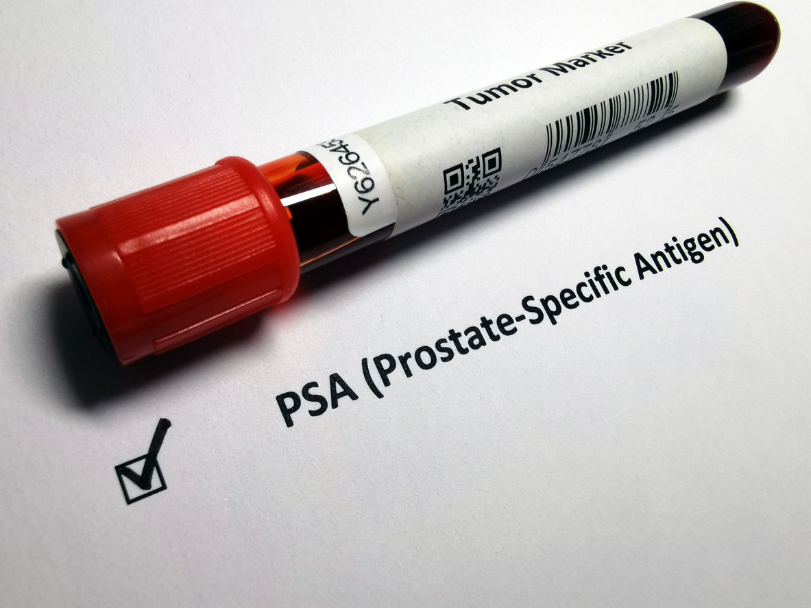 El test que acerca a más hombres al diagnóstico precoz del cáncer de próstata