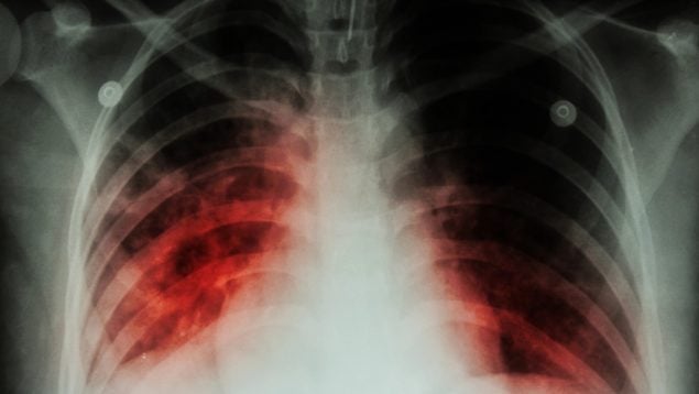 Tuberculosis
