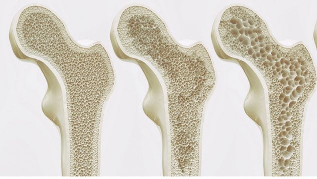 osteorporosis