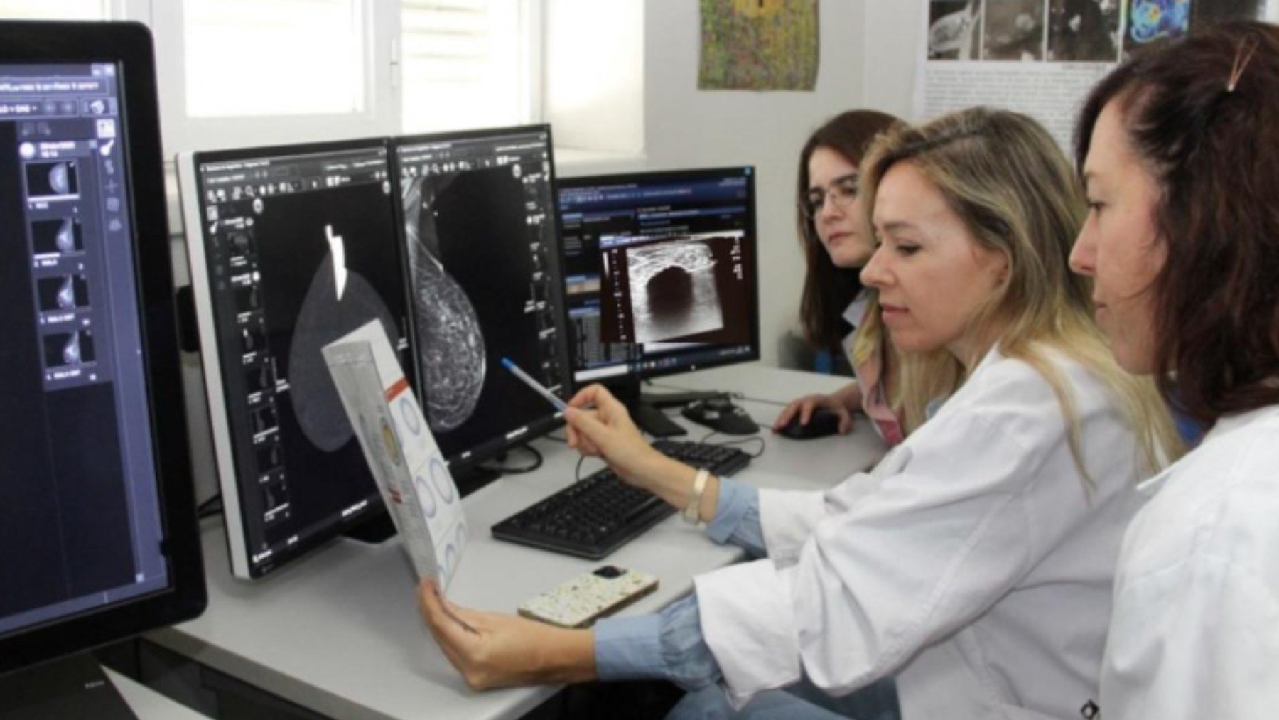 crioablación cáncer de mama