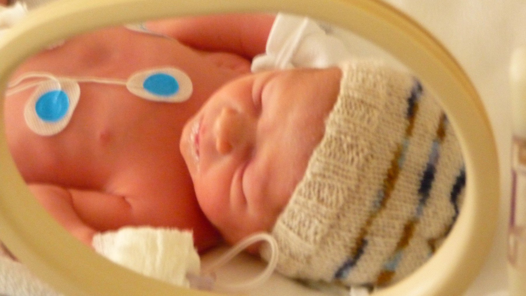 Un ‘bebé milagro’: HM implanta con éxito marcapasos MICRA epicárdico en un prematuro
