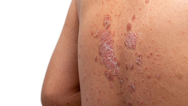 sindrome de steven johnson ibuprofeno