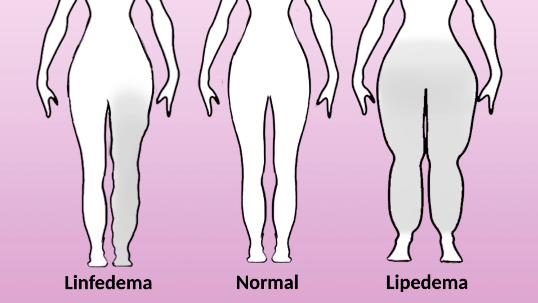 lipedema linfedema