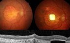 Chip ocular degeneración macular