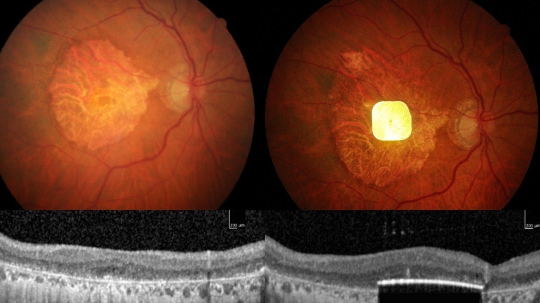 Chip ocular degeneración macular