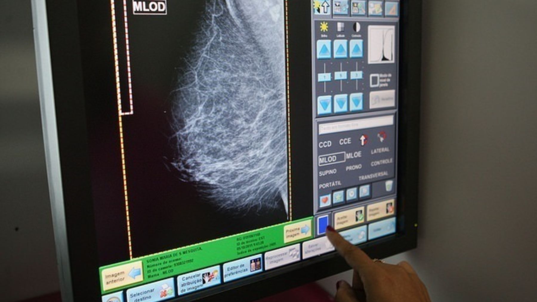 Inteligencia artificial, cáncer de mama