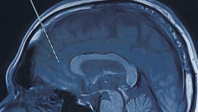 derrame cerebral cirugía