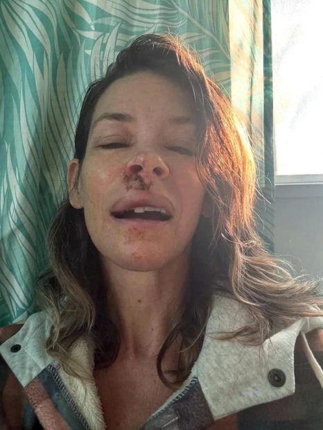 La actriz Evangeline Lilly muestra las secuelas de su accidente en una playa de Haw&aacute;i (Instagram).