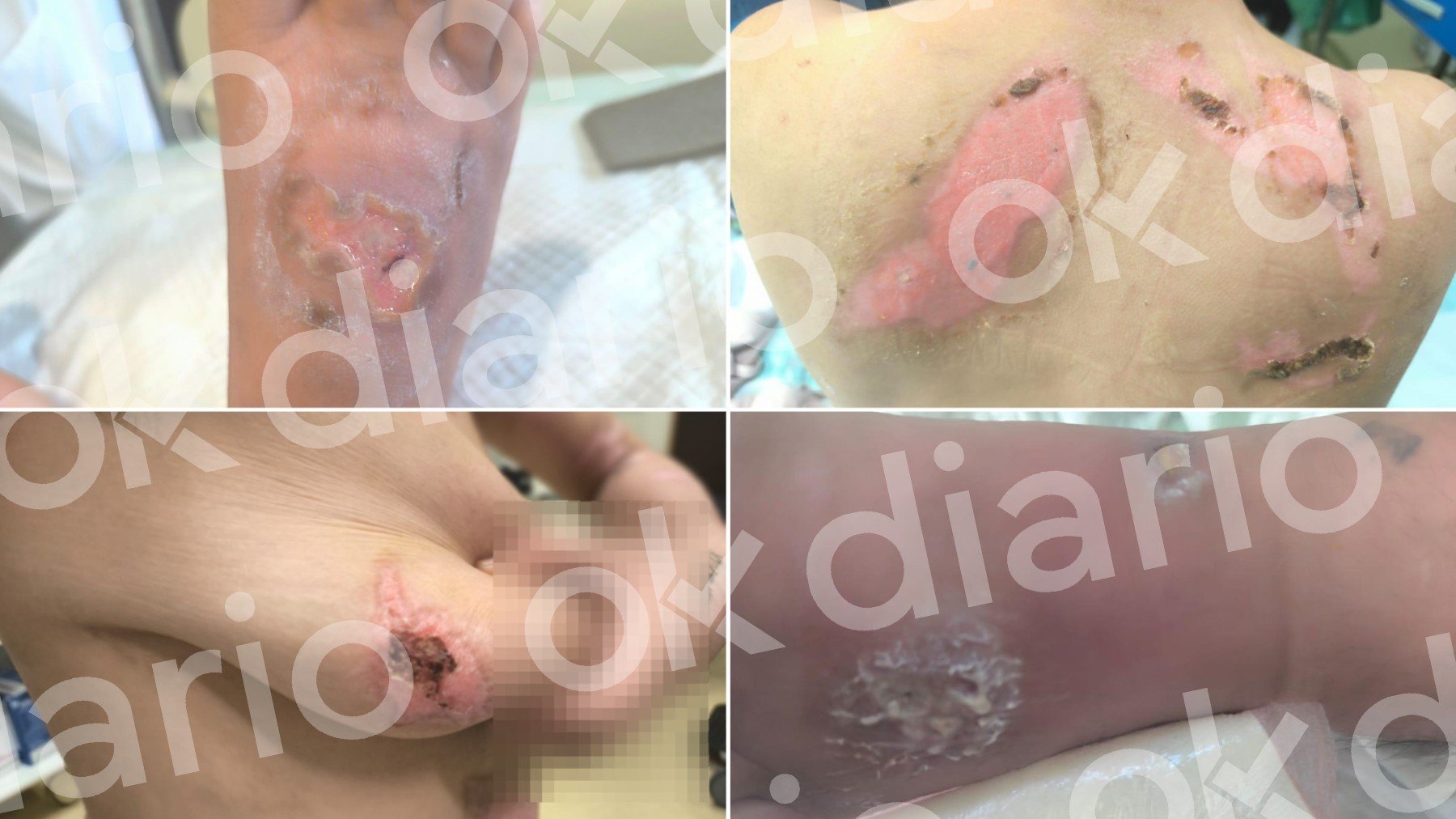 Las torturas de la joven esclavizada en Zaragoza: Me partieron 4 dedos a martillazos por negarme a fregar