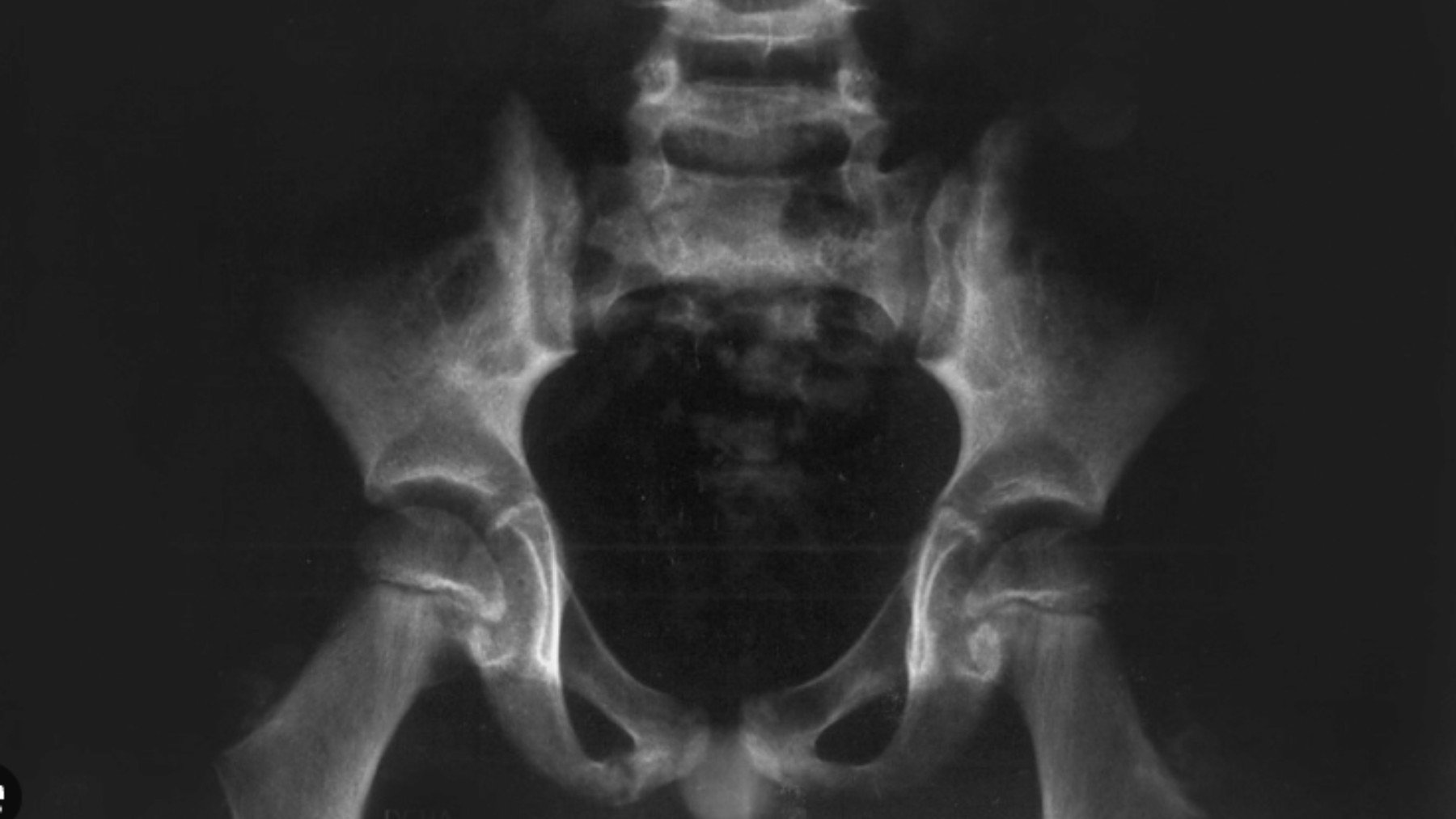 Qué es y cómo se trata la osteomielitis púbica, la enfermedad de Salvador Illa