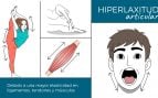 hiperlaxitud