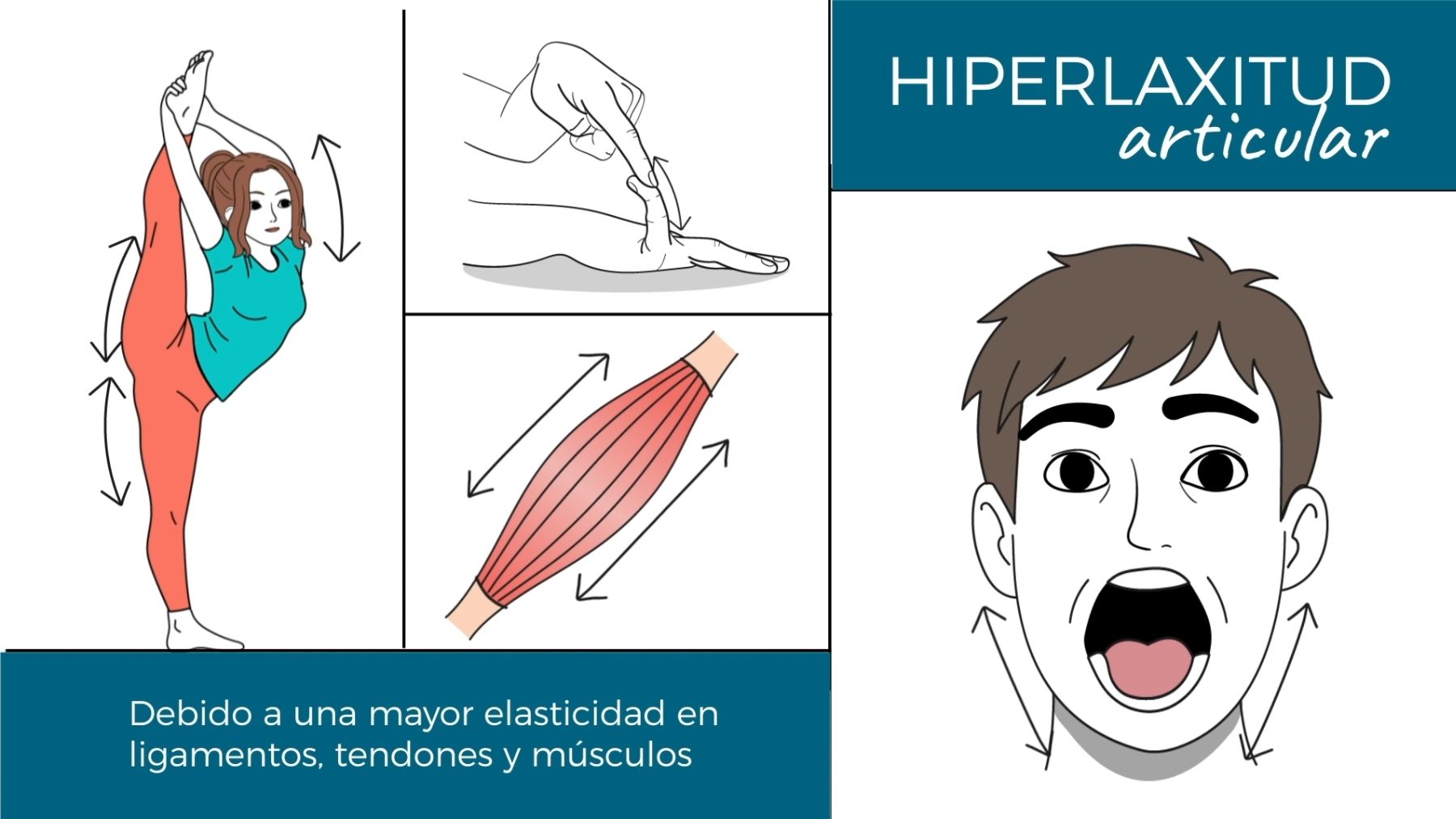 Cuando ser más flexible que la media se convierte en un problema de salud