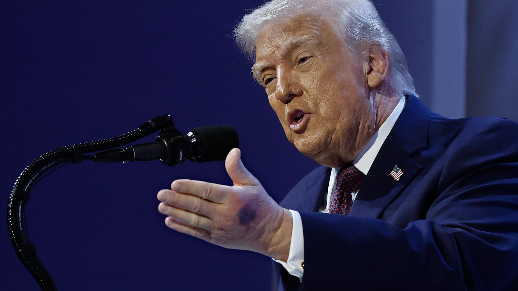 Trump podría sufrir insuficiencia venosa crónica: los moretones que han vuelto a encender el debate