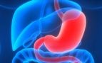 ¿Debemos preocuparnos por el uso de medicamentos contra el reflujo y el riesgo de cáncer gástrico?