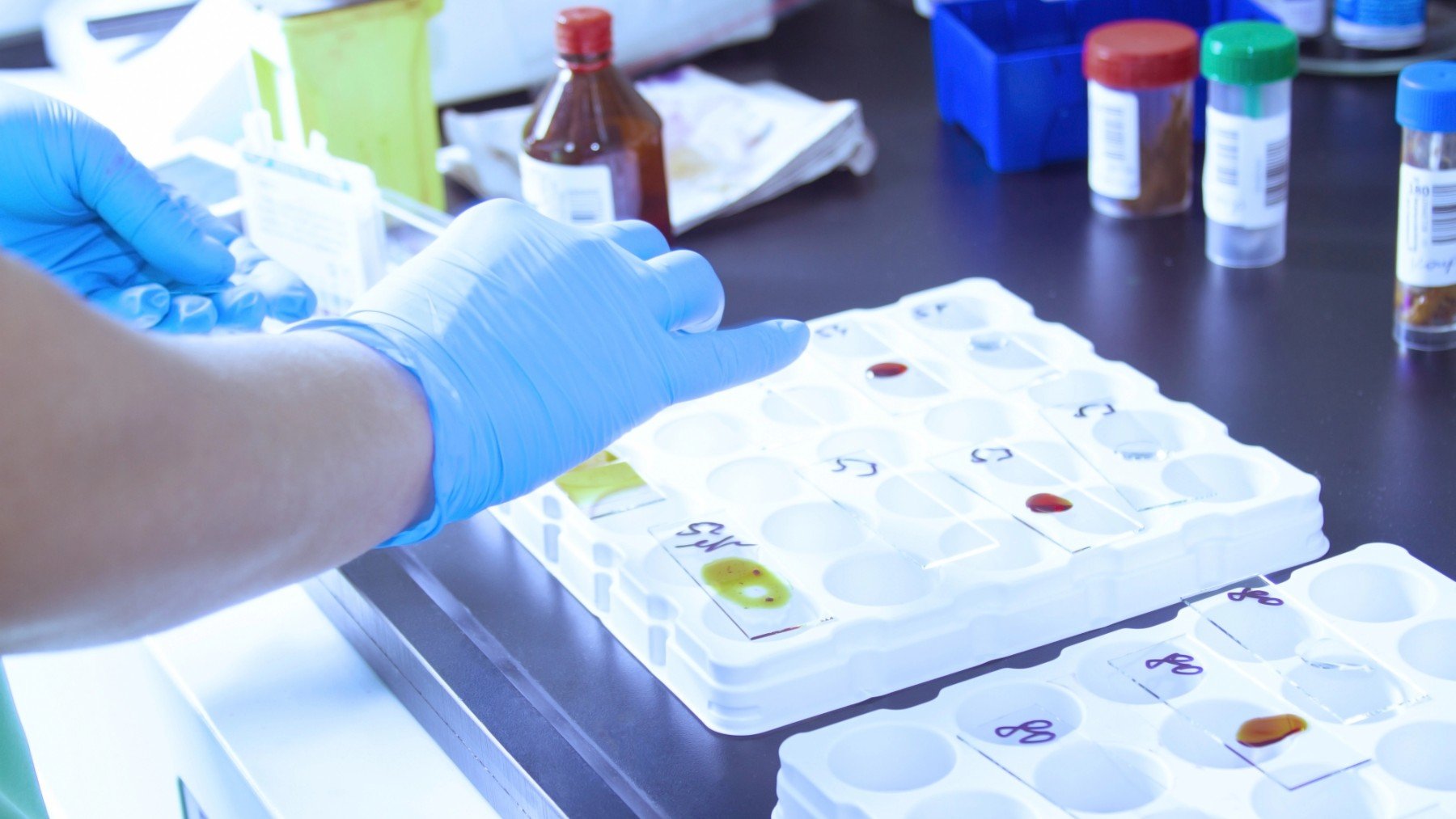 Oncólogos exigen incorporar al sistema sanitario la biopsia líquida para mejorar el manejo del cáncer