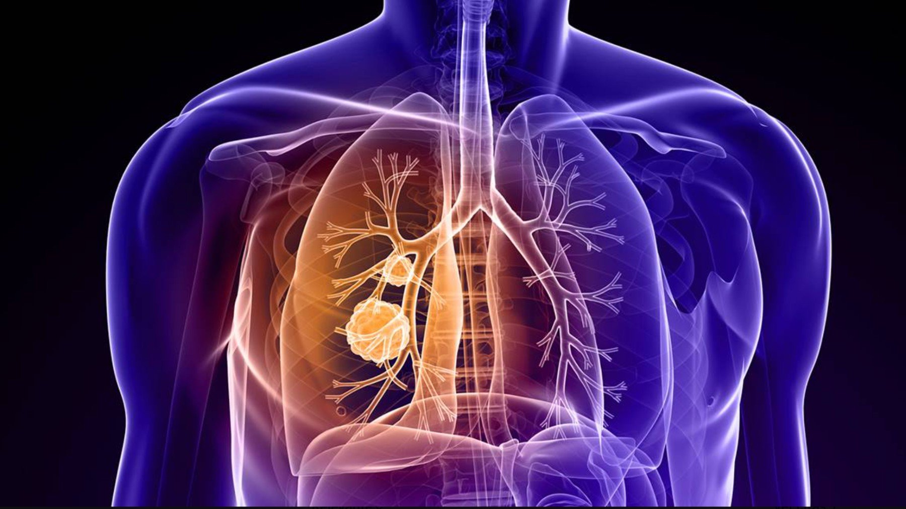 Qué es el radón: el gas silencioso que eleva el riesgo de cáncer de pulmón en personas no fumadoras