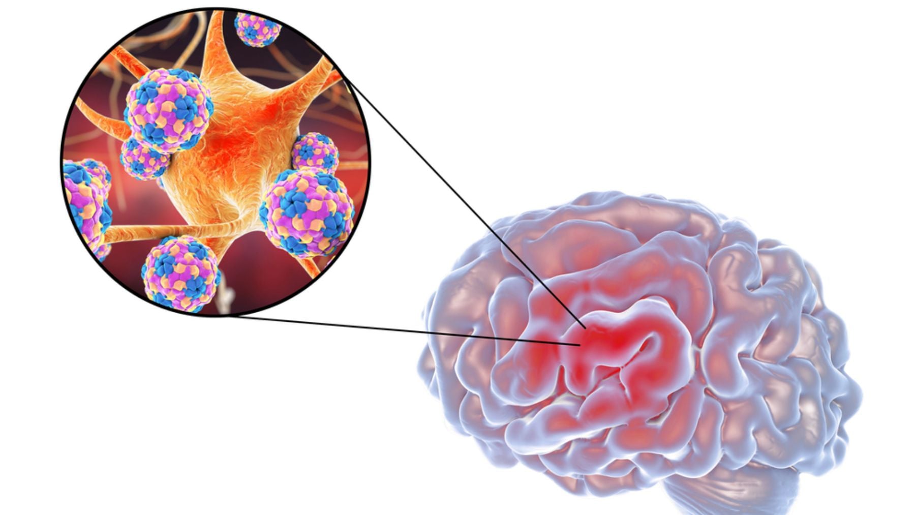 Encefalitis: qué hay detrás de esta enfermedad neurológica que deja secuelas en el 20% de los afectados