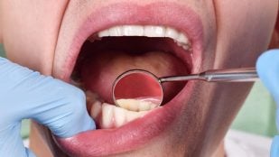 caries