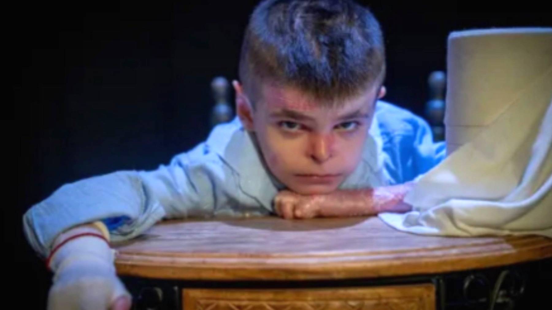 Mónica García le niega un tratamiento de cura al niño que sufre la enfermedad de piel de mariposa