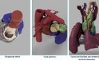 La Fundación Jiménez Díaz destaca «la precisión y eficacia» de la cirugía cardiaca guiada por modelos 3D
