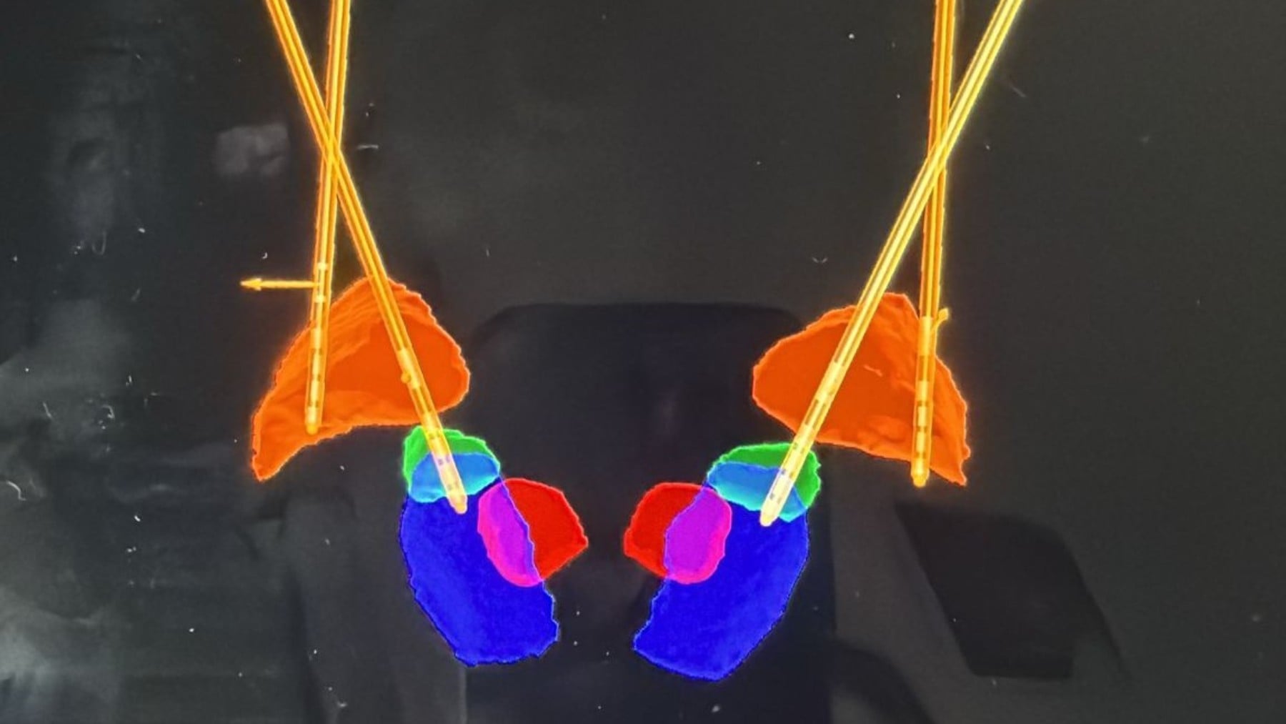 Una innovadora estrategia con cuatro electrodos devuelve la vida normal a un paciente con Parkinson