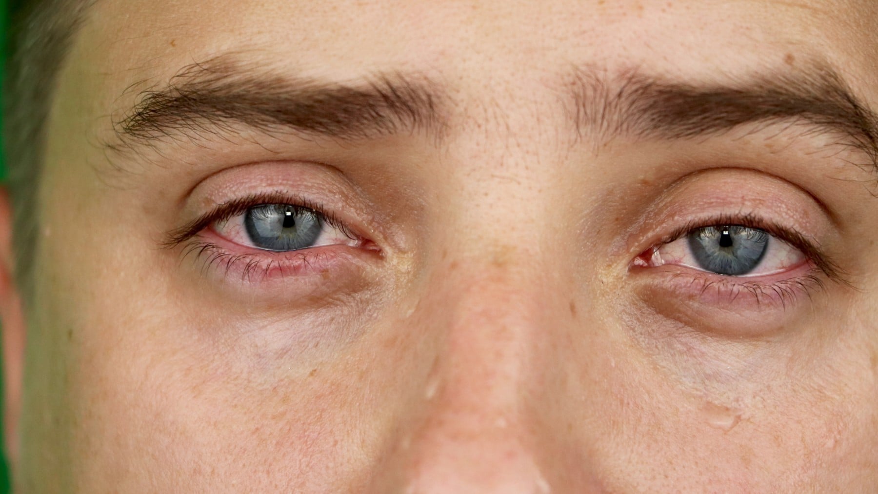 Alerta por un virus marino que podría infectar a humanos y causar una enfermedad ocular similar al glaucoma