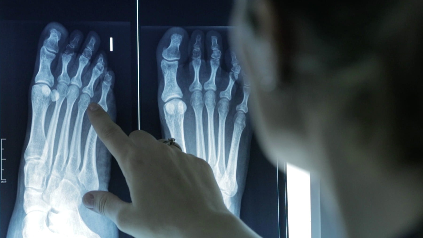 Por qué el 60% de los adultos padece deformidades en los dedos de los pies: estos son los tratamientos