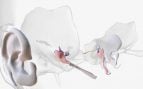 Implantes cocleares