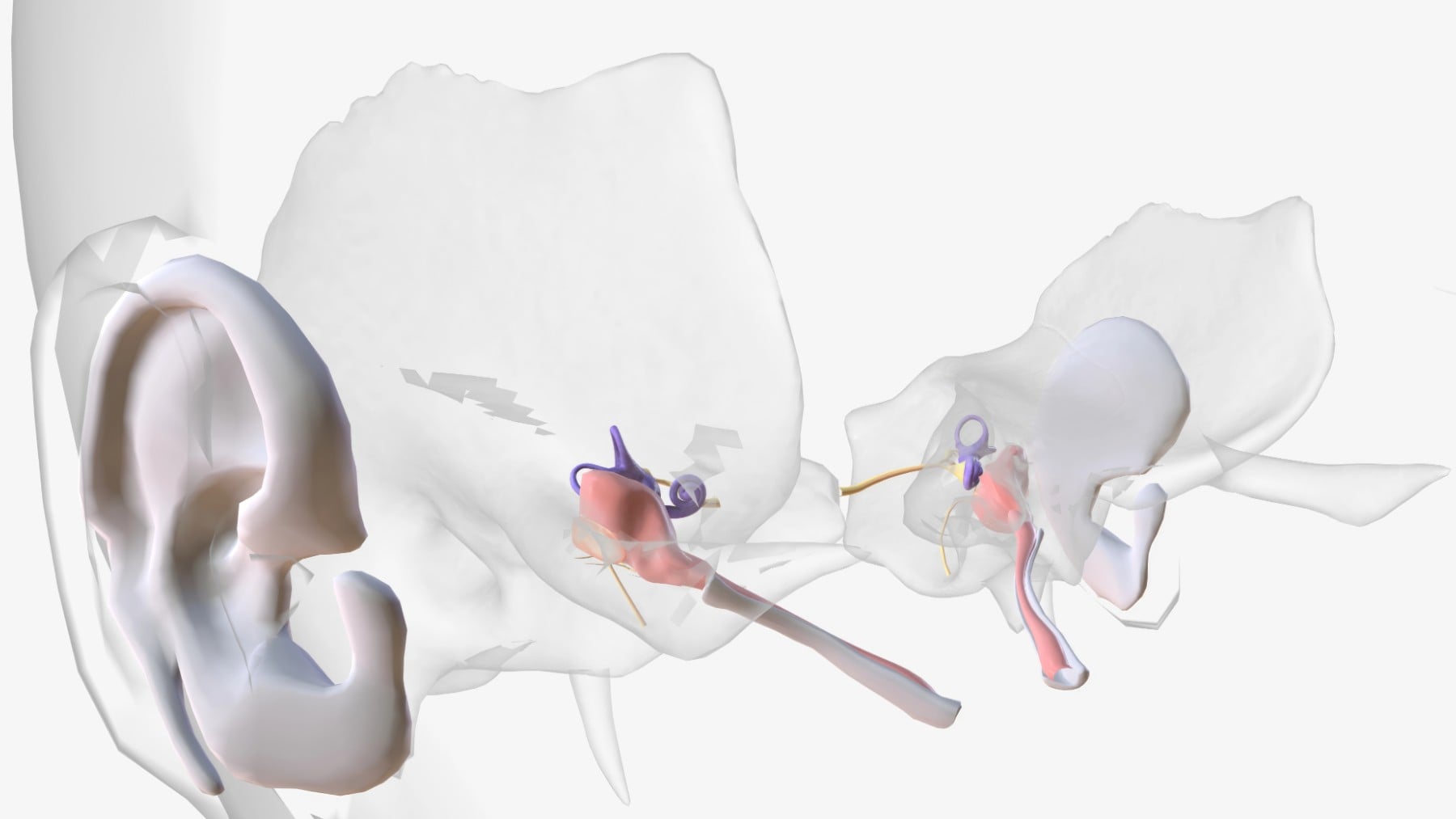 Implantes cocleares: cómo funciona la innovadora cirugía robótica en el Hospital La Paz