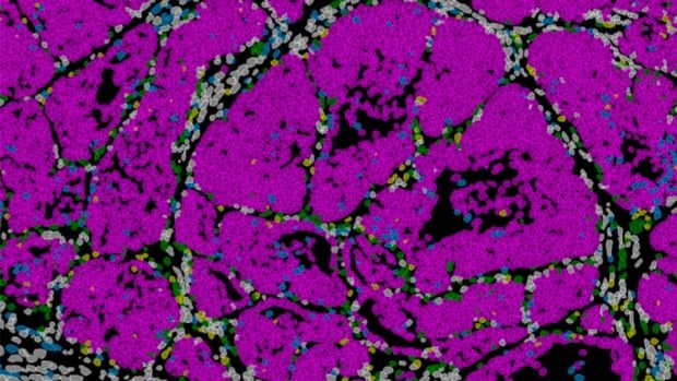 Tumor de mama en rat&oacute;n con c&eacute;lulas cancerosas (rosa). IN CSIC-UMH