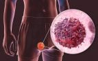 Cáncer de testículo
