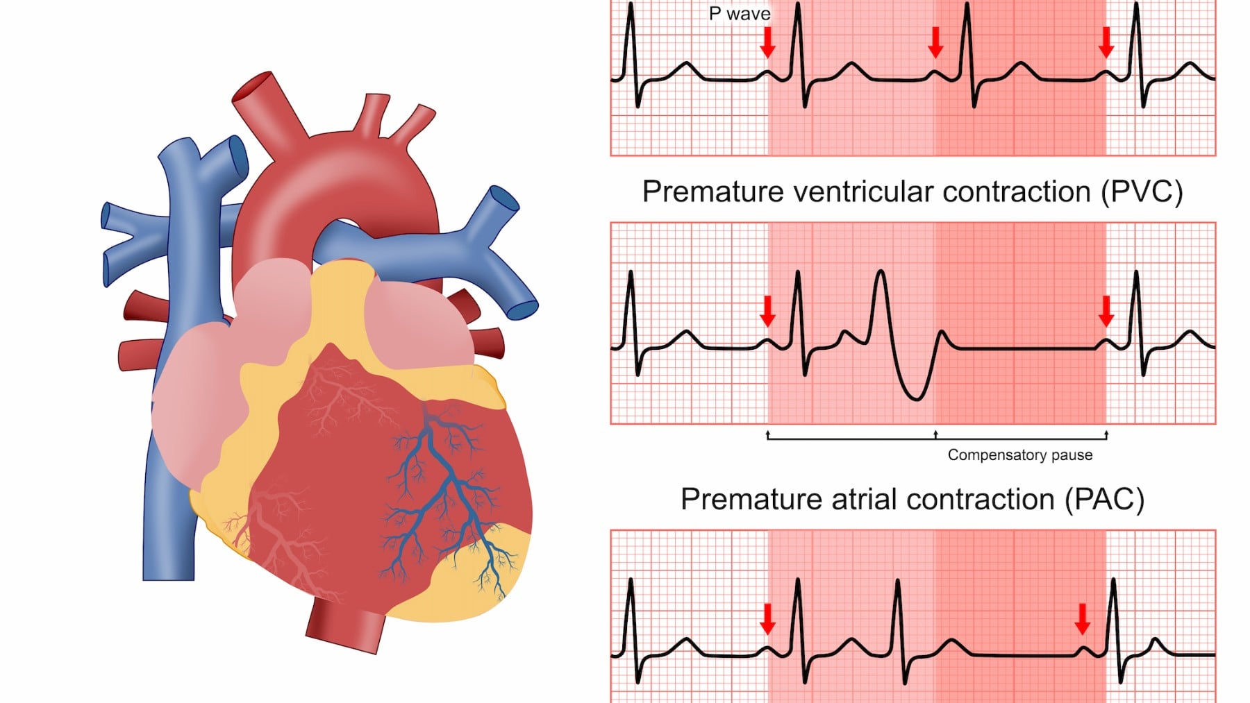 España registra el mayor aumento por muerte súbita en Europa, un 3,3% anual en una década