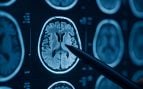 Cirugía cerebral sin huellas: el Dr. Hugo Santos Benítez explica las ventajas de la neuroendoscopia