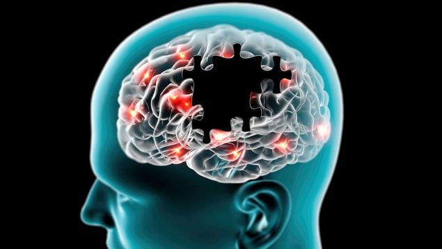 Tumor cerebral. @Archivo