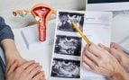 El síndrome de ovario poliquístico (SOP) ha sido renombrado oficialmente como síndrome ovárico metabólico poliendocrino (SOMP)