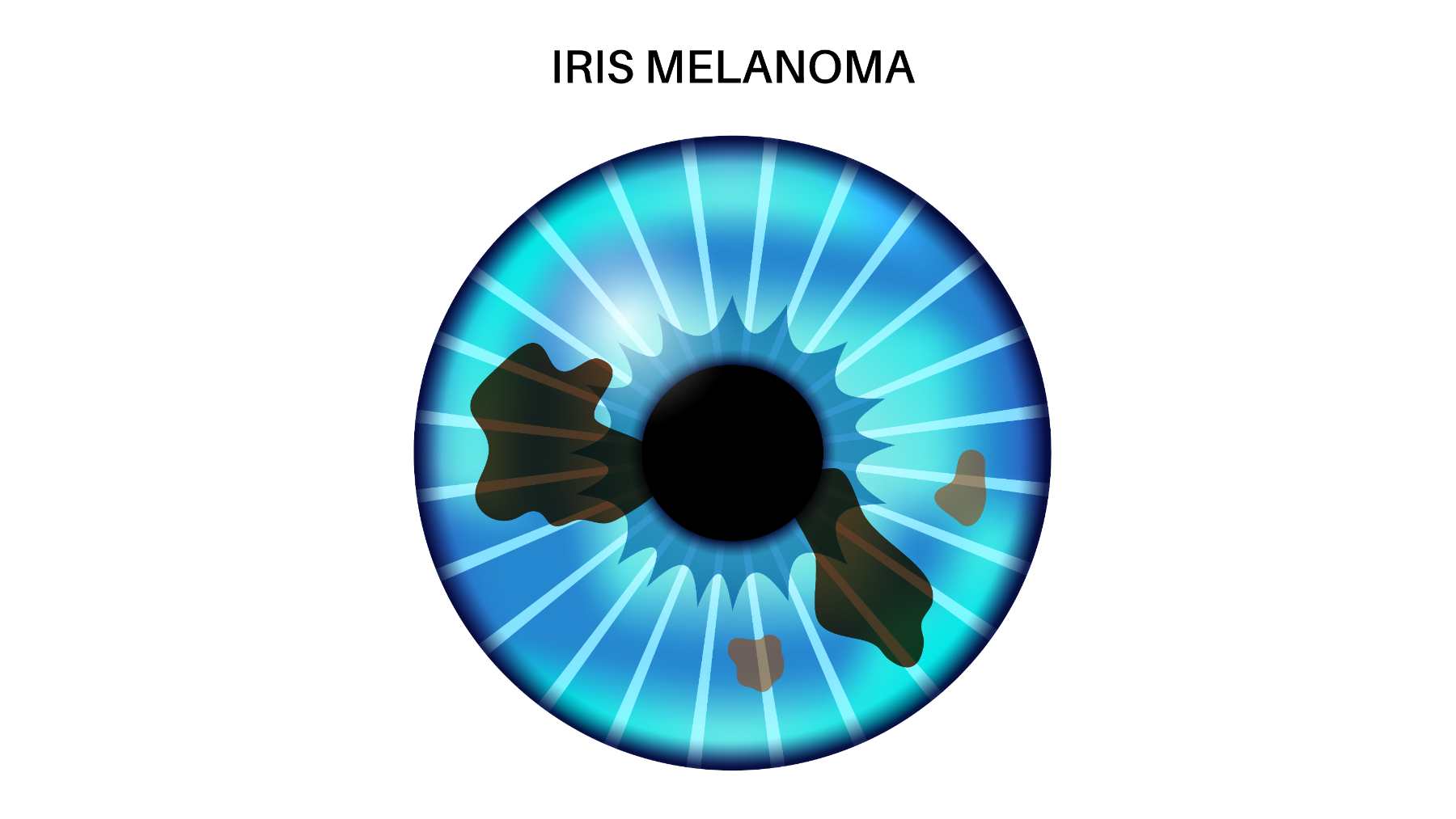 Melanoma ocular: el cáncer