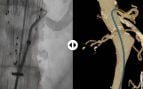 Una nueva tecnología guiada por luz permite visualizar catéteres y guías en 3D durante procedimientos endovasculares