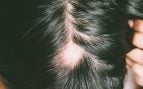 La alopecia