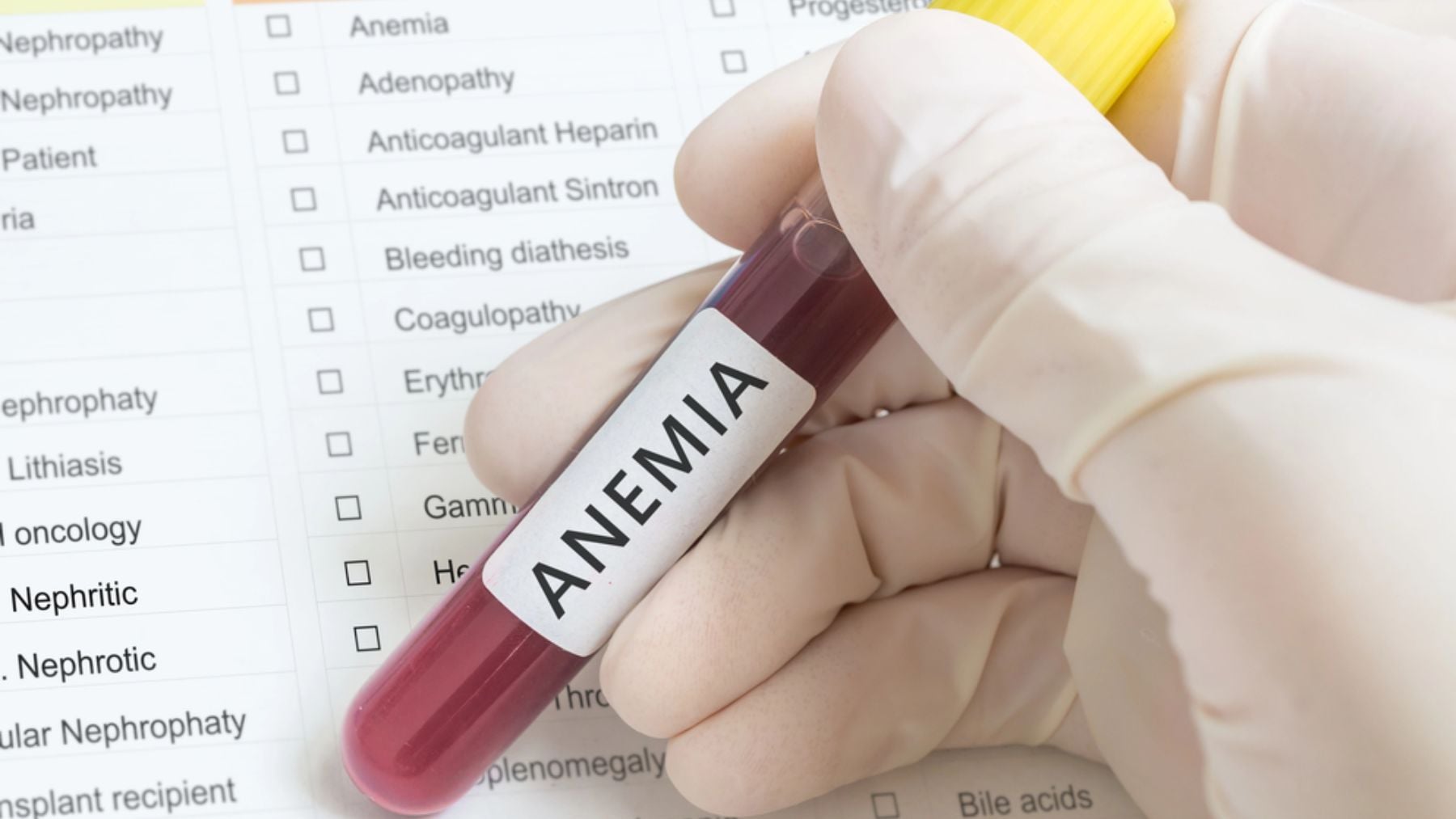 Estos son los tres síntomas más comunes cuando hay anemia y que se confunden con estrés