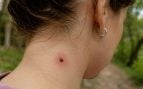 Garrapatas, animales, curiosidades, truco