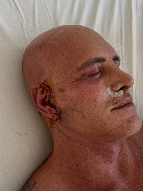 Kiko Matamoros tras su nueva cirug&iacute;a est&eacute;tica. (Instagram)