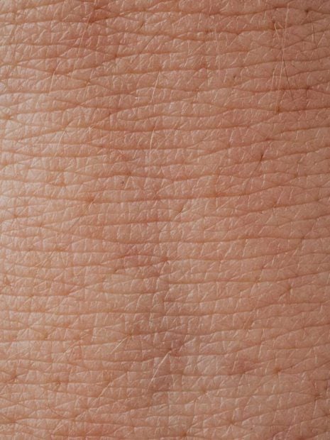 celulitis