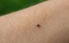 fiebre congo