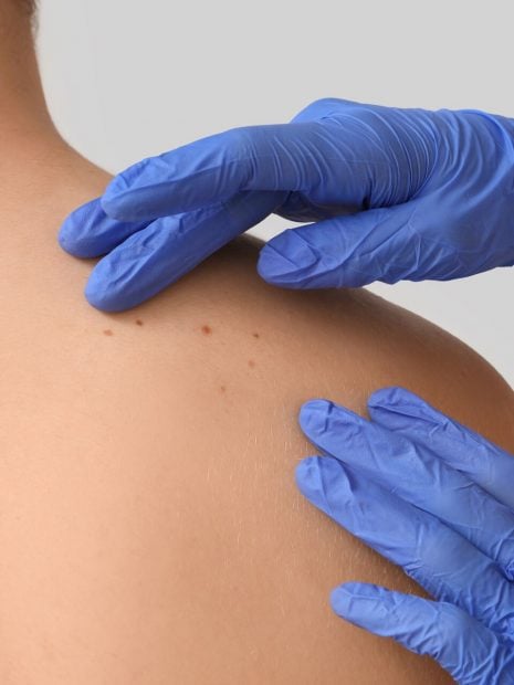 lunares piel verano vigilar dermatologo