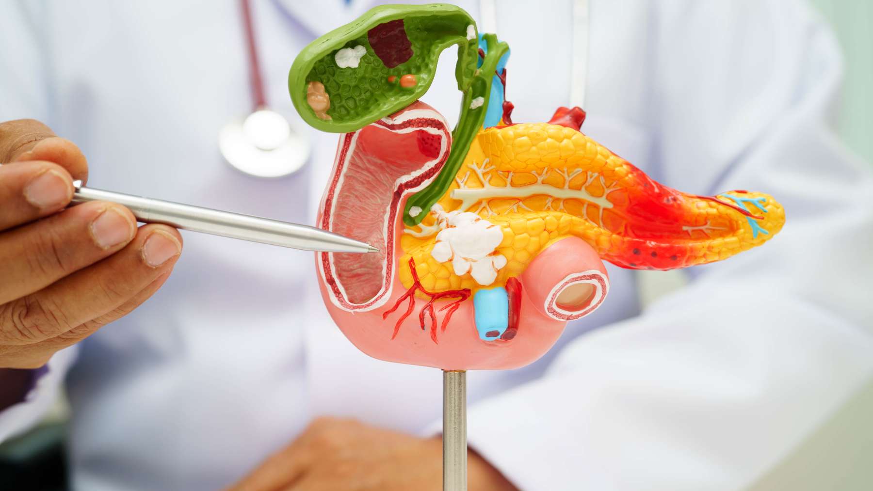 Una vacuna experimental abre la puerta a prevenir el cáncer de páncreas en personas de alto riesgo